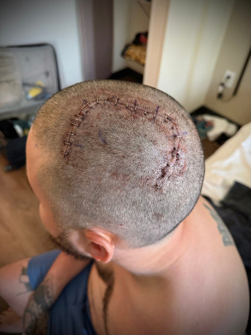 Neuralink Patient Shares Post-Surgery Photo: What It Tells Us