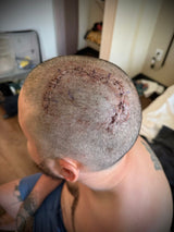 Neuralink Patient Shares Post-Surgery Photo: What It Tells Us